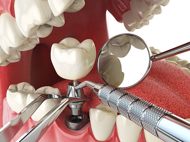 Best Emergency Cosmetic Dentistry (e.g., broken veneers) in Mill Valley, CA